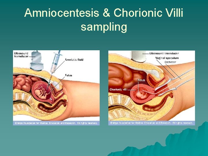 Amniocentesis & Chorionic Villi sampling 