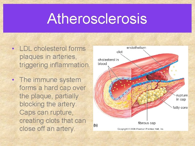 Atherosclerosis • LDL cholesterol forms plaques in arteries, triggering inflammation. • The immune system