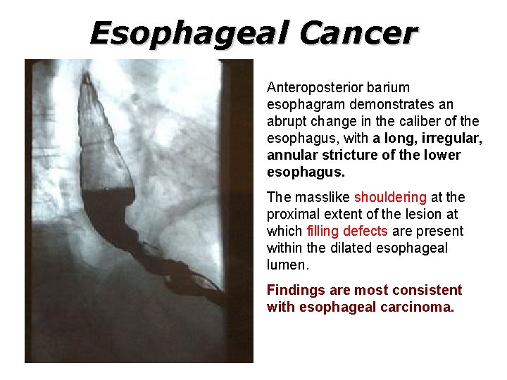 Esophageal Cancer Anteroposterior barium esophagram demonstrates an abrupt change in the caliber of the