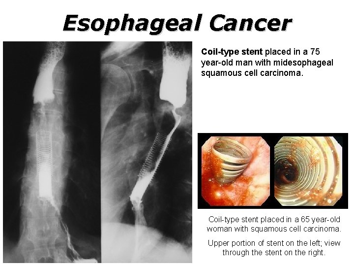 Esophageal Cancer Coil-type stent placed in a 75 year-old man with midesophageal squamous cell