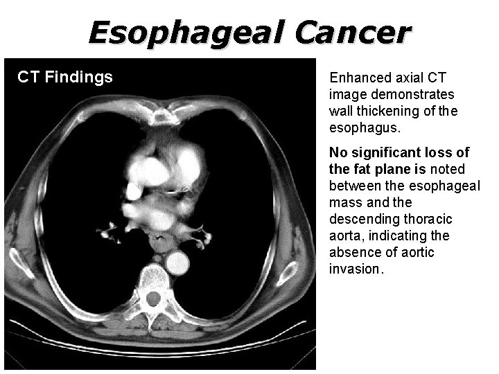 Esophageal Cancer CT Findings Enhanced axial CT image demonstrates wall thickening of the esophagus.