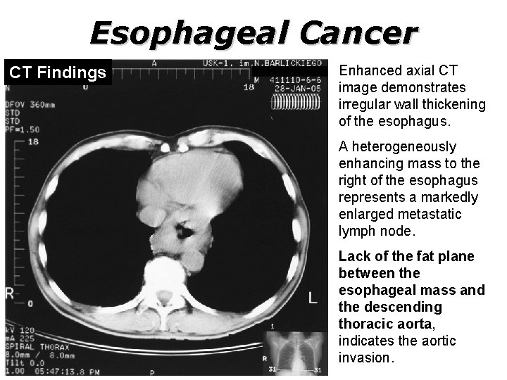 Esophageal Cancer CT Findings Enhanced axial CT image demonstrates irregular wall thickening of the