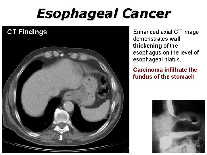 Esophageal Cancer CT Findings Enhanced axial CT image demonstrates wall thickening of the esophagus