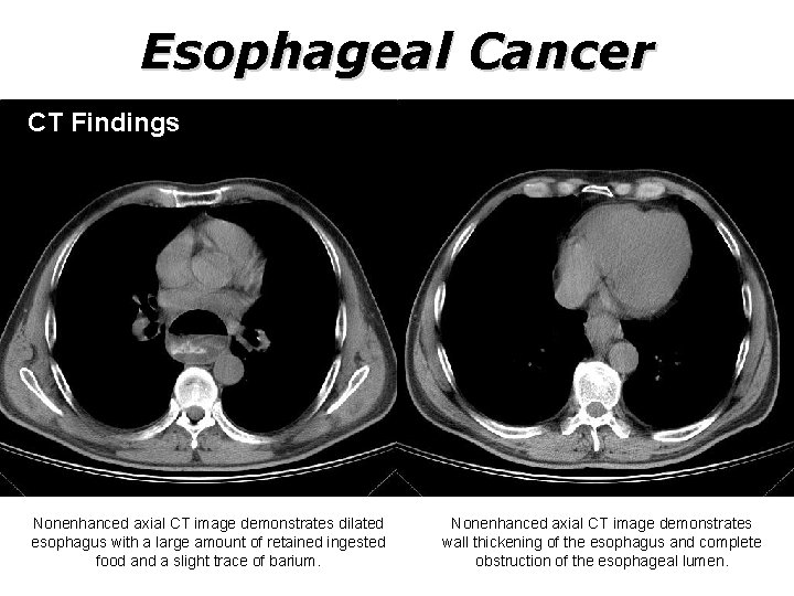 Esophageal Cancer CT Findings Nonenhanced axial CT image demonstrates dilated esophagus with a large