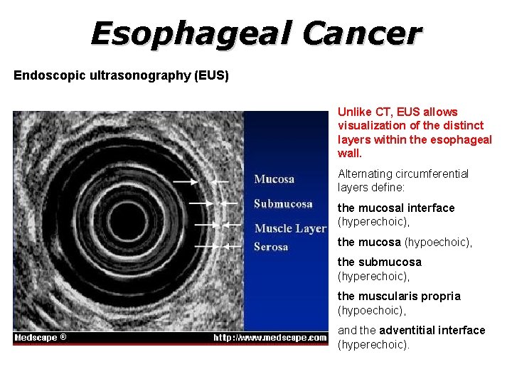 Esophageal Cancer Endoscopic ultrasonography (EUS) Unlike CT, EUS allows visualization of the distinct layers