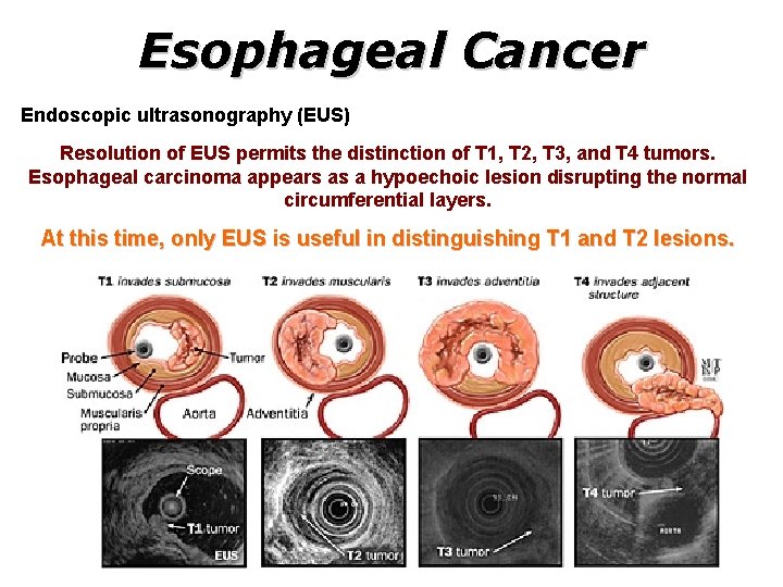 Esophageal Cancer Endoscopic ultrasonography (EUS) Resolution of EUS permits the distinction of T 1,