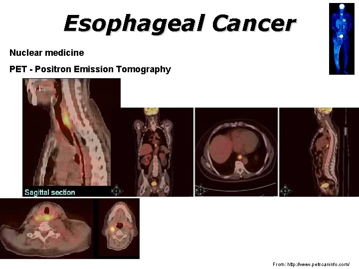 Esophageal Cancer Nuclear medicine PET - Positron Emission Tomography From: http: //www. petscaninfo. com/