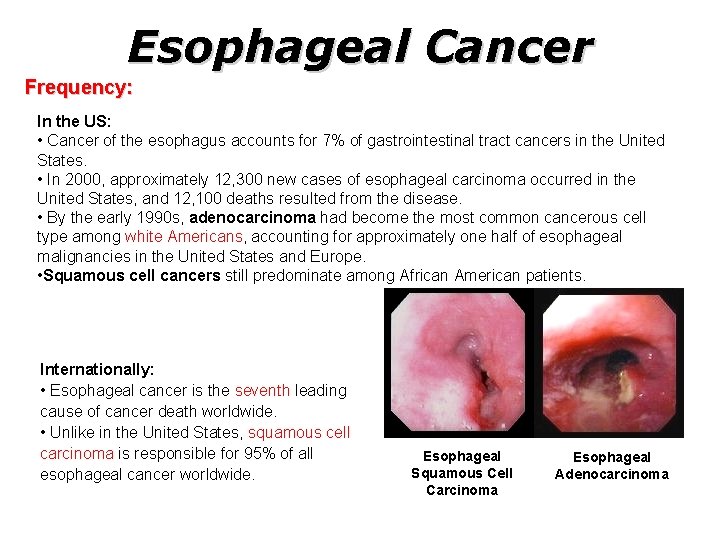 Esophageal Cancer Frequency: In the US: • Cancer of the esophagus accounts for 7%