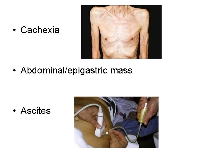  • Cachexia • Abdominal/epigastric mass • Ascites 