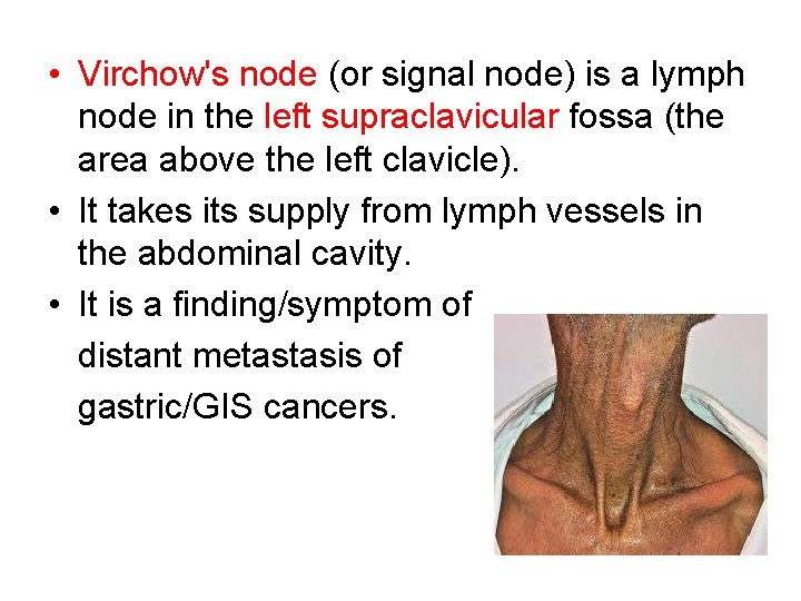  • Virchow's node (or signal node) is a lymph node in the left