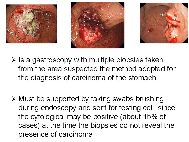 Ø Is a gastroscopy with multiple biopsies taken from the area suspected the method