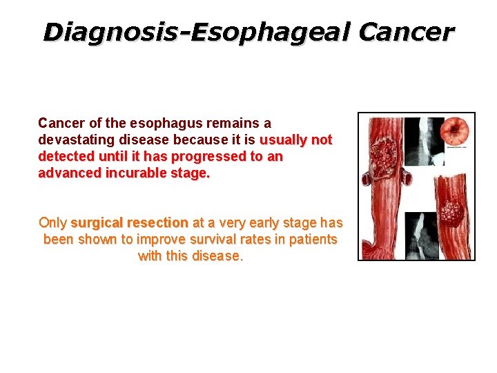 Diagnosis-Esophageal Cancer of the esophagus remains a devastating disease because it is usually not