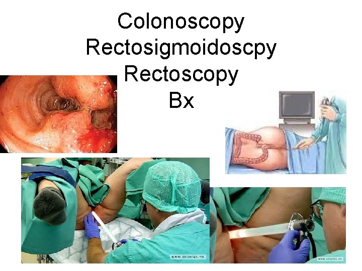 Colonoscopy Rectosigmoidoscpy Rectoscopy Bx 