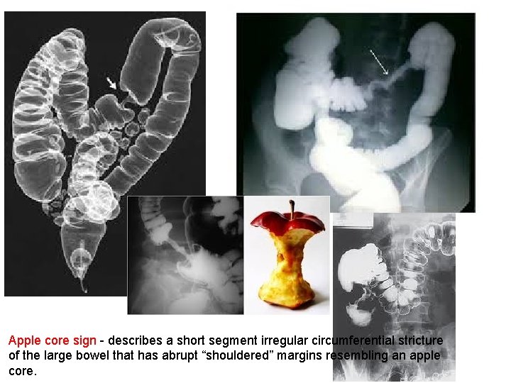 Apple core sign - describes a short segment irregular circumferential stricture of the large