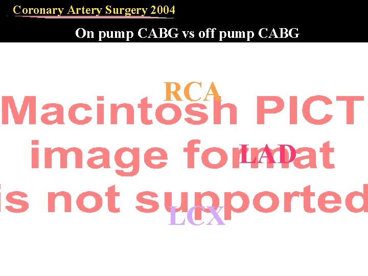 Coronary Artery Surgery 2004 On pump CABG vs off pump CABG RCA LAD LCX