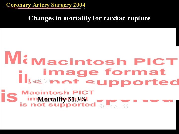 Coronary Artery Surgery 2004 Changes in mortality for cardiac rupture Death 30 Mortality 31.