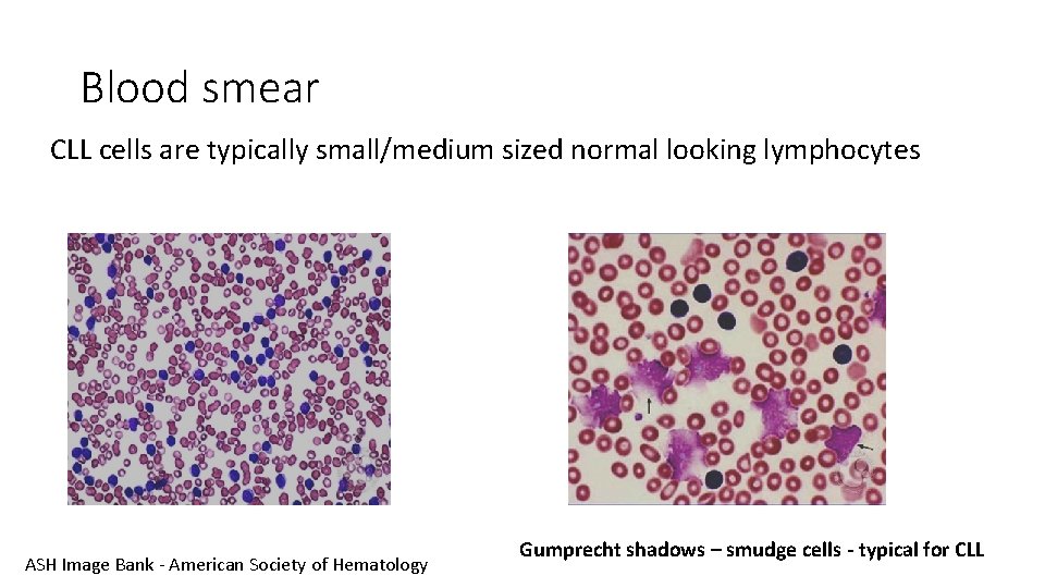 Blood smear CLL cells are typically small/medium sized normal looking lymphocytes ASH Image Bank