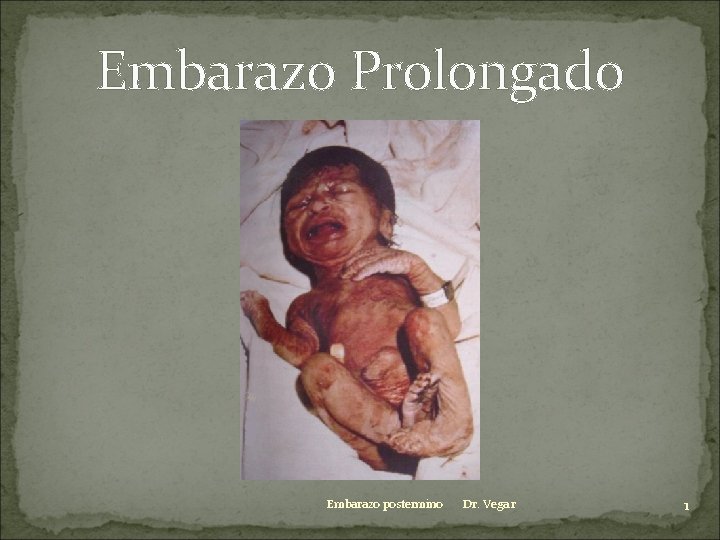 Embarazo Prolongado Embarazo postermino Dr. Vega r 1 