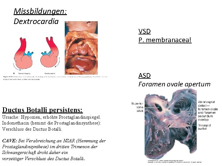 Missbildungen: Dextrocardia VSD P. membranacea! ASD Foramen ovale apertum Ductus Botalli persistens: Ursache: Hypoxien,