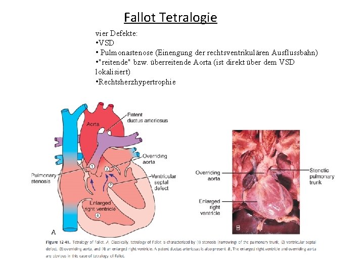 Fallot Tetralogie vier Defekte: • VSD • Pulmonastenose (Einengung der rechtsventrikulären Ausflussbahn) • "reitende"