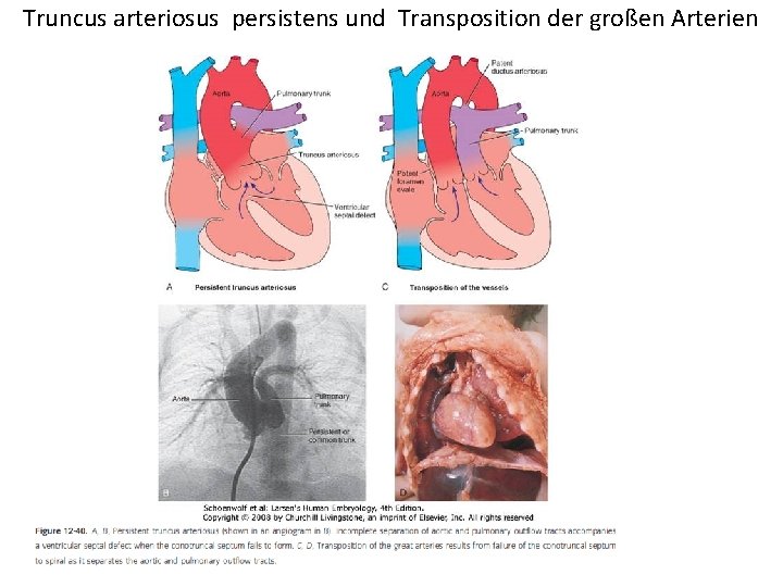 Truncus arteriosus persistens und Transposition der großen Arterien 