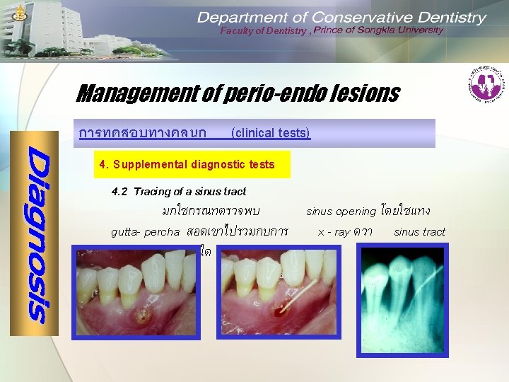 Faculty of Dentistry , Management of perio-endo lesions การทดสอบทางคลนก (clinical tests) 4. Supplemental diagnostic