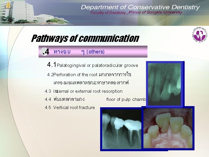 Faculty of Dentistry , Pathways of communication. 4 ทางอน ๆ (others) 4. 1 Palatogingival