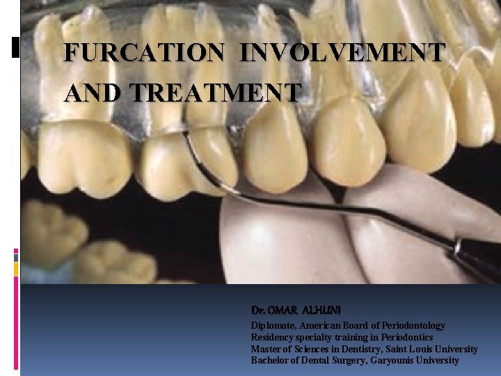 FURCATION INVOLVEMENT TREATMENT OF FURCATIONAND TREATMENT INVOLVED TEETH Dr. OMAR ALHUNI Diplomate, American Board