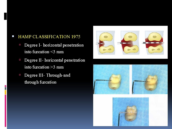  HAMP CLASSIFICATION 1975 Degree I- horizontal penetration into furcation <3 mm Degree II-