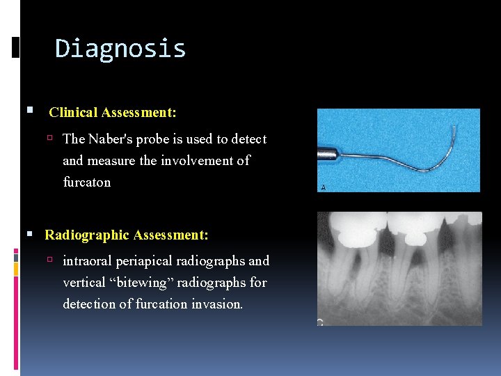 Diagnosis Clinical Assessment: The Naber's probe is used to detect and measure the involvement