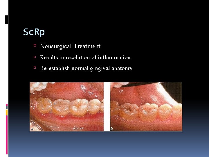 Sc. Rp Nonsurgical Treatment Results in resolution of inflammation Re-establish normal gingival anatomy 