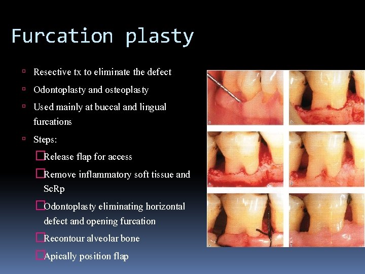 Furcation plasty Resective tx to eliminate the defect Odontoplasty and osteoplasty Used mainly at