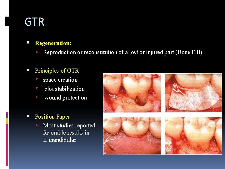 GTR Regeneration: Reproduction or reconstitution of a lost or injured part (Bone Fill) Principles