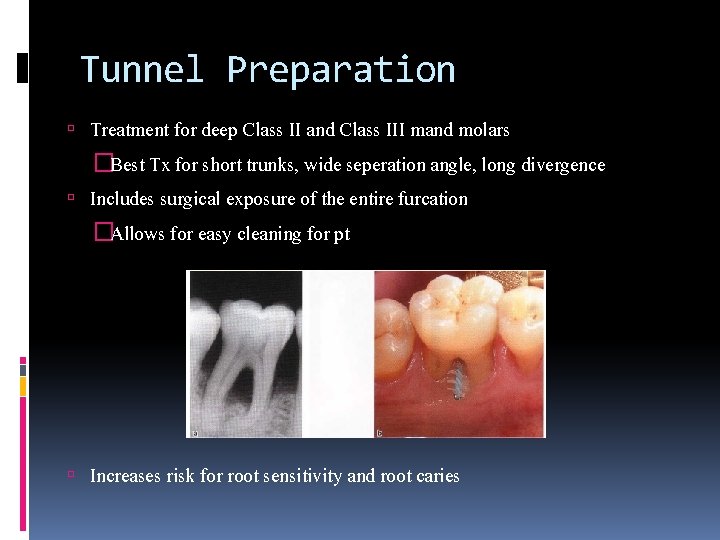 Tunnel Preparation Treatment for deep Class II and Class III mand molars �Best Tx