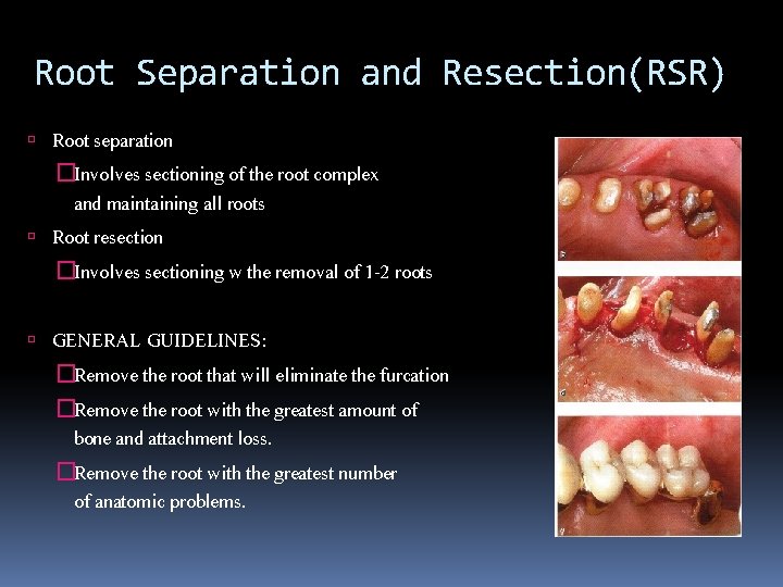 Root Separation and Resection(RSR) Root separation �Involves sectioning of the root complex and maintaining