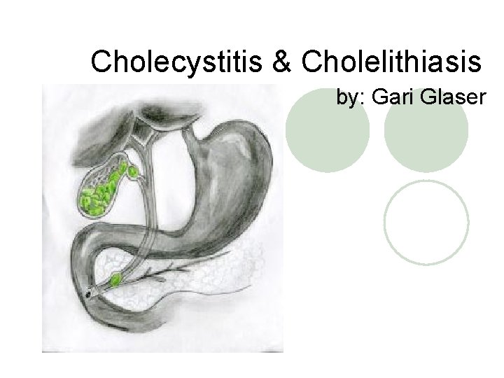 Cholecystitis & Cholelithiasis by: Gari Glaser 