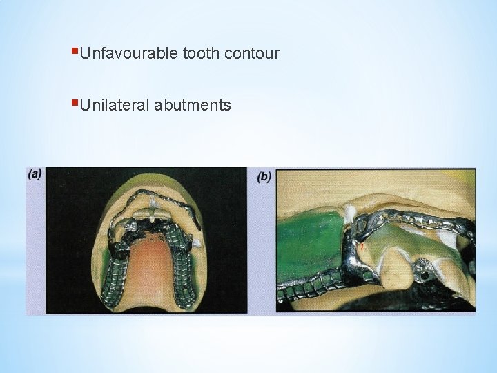 §Unfavourable tooth contour §Unilateral abutments 