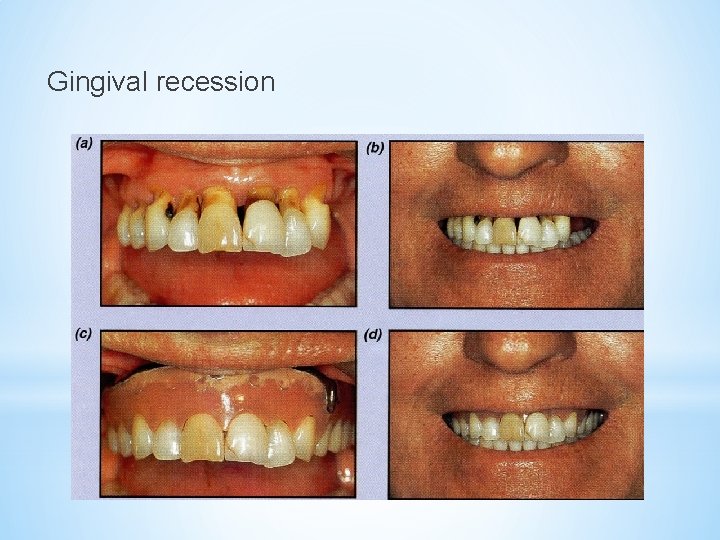 Gingival recession 