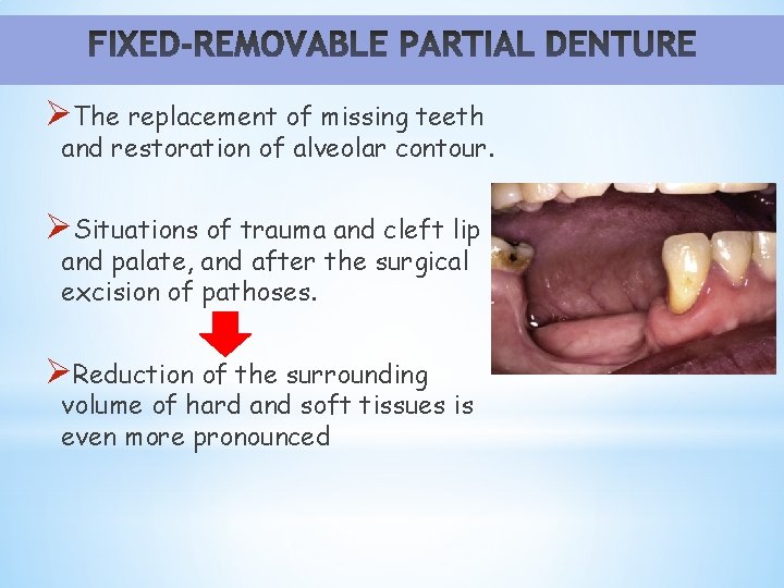 ØThe replacement of missing teeth and restoration of alveolar contour. ØSituations of trauma and