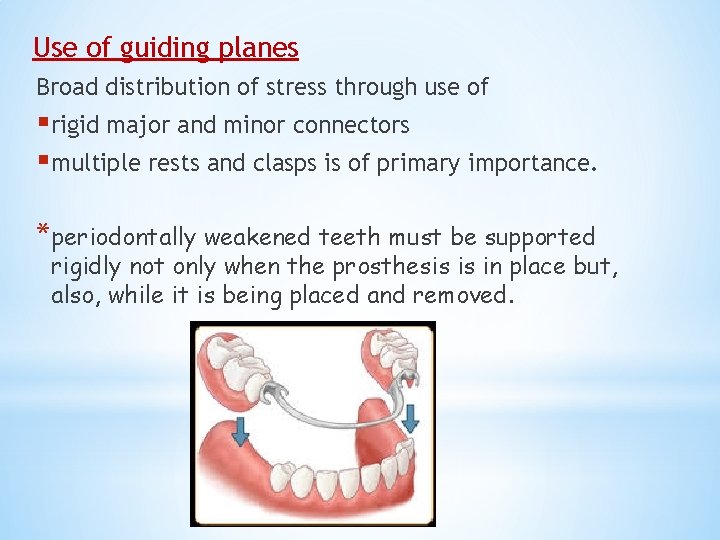 Use of guiding planes Broad distribution of stress through use of §rigid major and