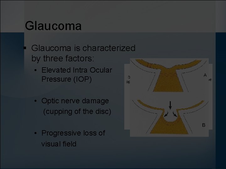 Glaucoma § Glaucoma is characterized by three factors: • Elevated Intra Ocular Pressure (IOP)
