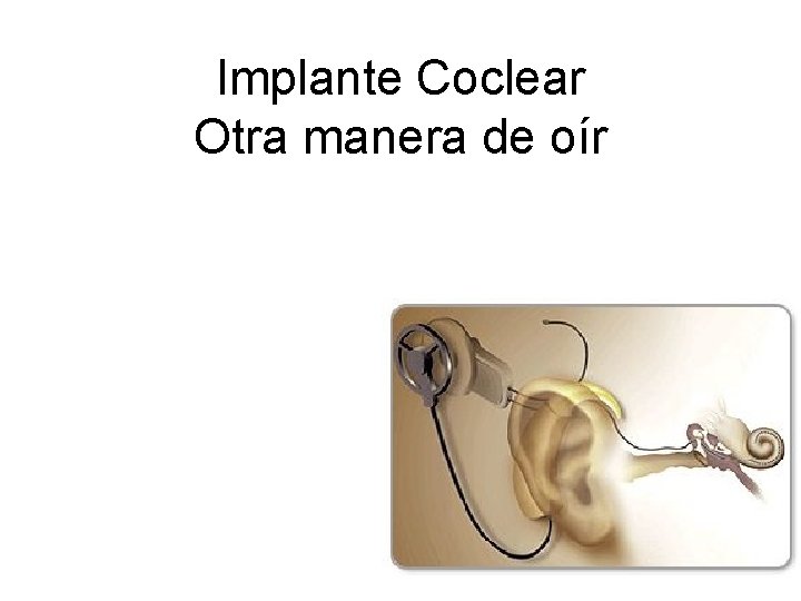 Implante Coclear Otra manera de oír 