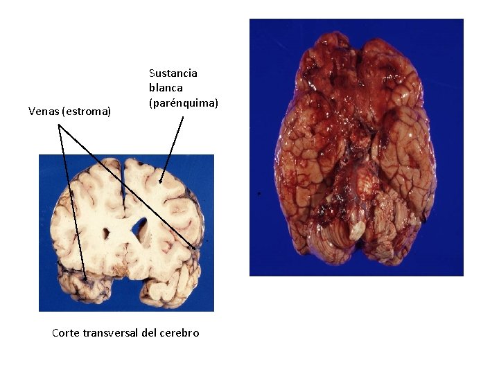 Venas (estroma) Sustancia blanca (parénquima) Corte transversal del cerebro 