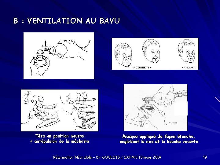 B : VENTILATION AU BAVU Tête en position neutre + antépulsion de la mâchoire