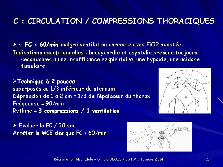 C : CIRCULATION / COMPRESSIONS THORACIQUES si FC < 60/min malgré ventilation correcte avec