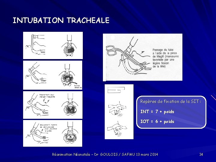 INTUBATION TRACHEALE Repères de fixation de la SIT : INT = 7 + poids