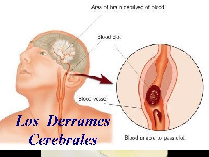 Los Derrames Cerebrales 