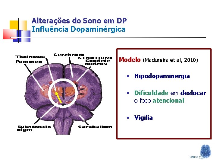 Alterações do Sono em DP Influência Dopaminérgica Modelo (Madureira et al, 2010) § Hipodopaminergia