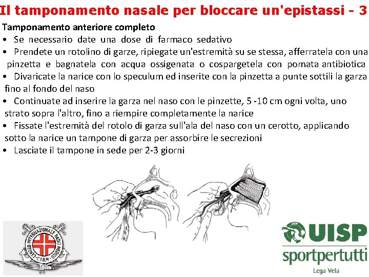 Il tamponamento nasale per bloccare un'epistassi - 3 Tamponamento anteriore completo • Se necessario