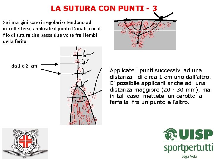 LA SUTURA CON PUNTI - 3 Se i margini sono irregolari o tendono ad